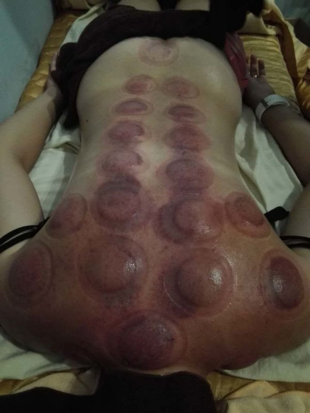 Unlocking the Mystery of Those Mysterious Red Circles: Experiencing Cupping in China